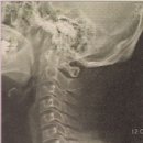 ﻿[목디스크] 척추뼈와 척추뼈 사이를 연결하는 디스크 충격을 흡수하는 쿠션장치! ﻿ 이미지