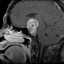 의외로 흔한 뇌암? ‘뇌하수체 종양’이란 이미지