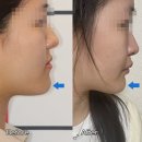 더시카고어린세상치과의원 | 양악수술 후회 뿐인 비용 후기