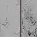 2012-45 경막 동정맥루 색전술 이미지