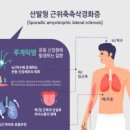 스티븐 호킹의 루게릭병 초기 증상 및 원인 수명은? 완치는 가능할까? 이미지