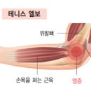 팔꿈치 통증 테니스엘보 골프엘보 이미지