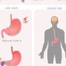 명치통증 답답함 등 명치가 아픈이유 이미지