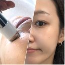 스킨바나나 | 피부관리 추천 [ 바나나부띠끄 ] 스킨부스터 미백 &#39;백설공주케어 프로모션&#39; 피부 전후 변화 솔직후기!