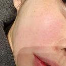 웰라스피부과의원 | 대치역 피부과 튠페이스 리프팅 잘하는곳 웰라스피부과 후기
