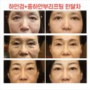 왜 이렇게 갑자기 젊어졌어? 분당하안검 로즈앤성형외과