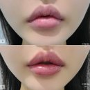 세븐일레븐노원제일점 B | 노원 입술필러 윗입술 말림 개선한 애프터 러시안립 후기