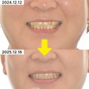 역곡치과의원 | 오류동교정치과 임상사례｜40대 성인교정, 지금 시작해도 괜찮을까요?