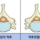 디스크와 비슷한 척추협착증, 증상구분과 예방 치료법 이미지