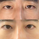 쉑쉑찜질카페 | 압구정성형외과에서 남자눈성형(눈매교정, 쌍꺼풀 수술)받은 후기: 이마 힘을 내려놓은 날