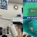 리빙스톤치과의원 | [치과리뷰] 매복 사랑니 발치 후기★