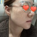 979 | 압구정| 루나의원 루비레이져 잡티제거 후기 979방 내돈내산