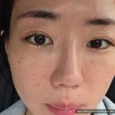루스킨엑스 AI 피부진단 받고 리투오 스킨부스터까지 받고 온 솔직후기