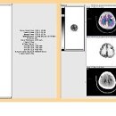 뇌종양 / 교모세포종 (glioblastoma) 이미지
