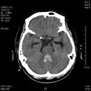 전산화단층촬영 두부 촬영 영상(ABNORMAL IMAGE) 이미지