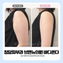라인 - 광산구 | 청담피부과 브랜뉴의원 바디온다 직접 받아본 팔뚝 라인 정리 후기