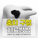 태미안 치과의원 | 치아 이빨 구멍 메우기 충치 치료 비용과 종류는