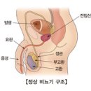 양성 전립선 비대증 이미지