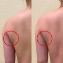 임효성힐링 | 대구 수성구 승모근경락/라운드숄더 해결해 주는 "임효성힐링" 솔직 후기