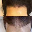 오늘의헤어 - 남동구 문화로115번길 47 | 광주 두피헤어라인 문신, 여자 M자 탈모 탈출 후기