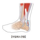 아킬레스건염 (Achilles tedonitis) 이미지