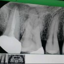 후기 추가) 진짜 죽고싶을 만큼 아팠던 치통 ..신경치료 후기 (재신경치료 / 치아 뿌리 염증) 이미지