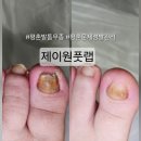 진케어 | 평촌 발톱무좀 관리 제이원풋랩 엄마의 두꺼워진 문제성발톱 케어 후기