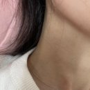 야당아주튼튼의원 | 편평사마귀 제거 내돈내산 후기 (전후 사진 / 편사 성지 / Co2 레이저/ 쥐젖까지 / 123갸 )