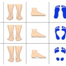 발바닥 통증 원인 예방법 이미지