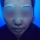 센텀모빅스피부과의원 | 부산 센텀모빅스 피부과에서 백반증 치료받은 생생 후기