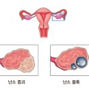 난소암 이미지