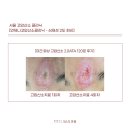 산소의원 | 언제나고압산소클리닉ㅣ서울 고압산소 서울 찰과상 화상 치료 가능한 365의원 심재성2도화상 고압산소 후기