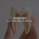 디지털아트 치과기공소 | 크라운, 어떤 치료인지 정확하게 알고 계신가요? | 신사역 디앙치과