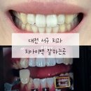 스마일치과의원 | 대전 서구 치아미백 잘하는곳 디지털스마일치과 후기｜자연스럽고 밝은 미백 효과 만족