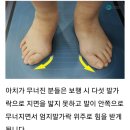 무지외반증 있는 사람들 빨리 아치 무너졌는지 확인해봐 이미지