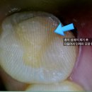 연세엘치과의원 | 하이브리드 인레이 가격, 얼마가 적정선일까? 치료 후기/ 수명/ 가격 총정리 [공덕동 치과]