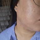 라더마의원 | [인천 서구 원당동] 리포유의원 내돈내산 리쥬란 2cc 일주일 후기