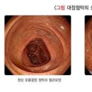 배에 가스 찼을때 증상 빼는법 약 장내 가스제거제 항콜린제 이미지