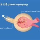 당뇨 신장병증 이미지