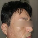 센텀모빅스피부과의원 | ((솔직후기)) 부산 센텀모빅스 피부과에서 받은 백반증 치료 후기