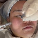 크리스탈피부과의원 | 홍대피부과 레스노베크리스탈 키토산스킨부스터효과 1주일 후기