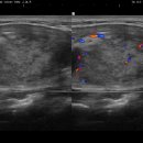 subacute thyroiditis 아급성 갑상선염 이미지