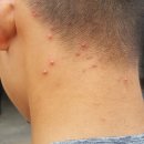 이현재피부과의원 | 부산 서면 이현재피부과 / 성인여드름 네오빔레이저 후기, 통증, 비용