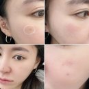 백자로 R | 의정부 피부과 얼굴 검버섯 흑자 제거 백자 리팟레이저 효과, 후기