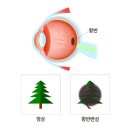 브니엘요양병원 | [양평/양평군 요양병원/브니엘 노인전문병원] [눈/코/귀/인후/구강/치아] 황반변성