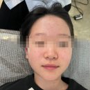 정발산역피부관리 에셀스킨 에서 중학생여드름관리 후기