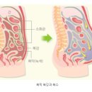 간암, 췌장암, 위암, 대장암, 유방암, 폐암, 난소암 치료 과정에서 복수가 찰 때 이미지