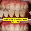나우커피인천시선학하루점 | 부평 치아미백, 하루 만에 밝아지는 원데이 치아미백 후기