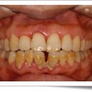 잇몸병에 의한 아래 앞니 상실시의 임플란트 회복 이미지