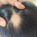 동수초등학교 | 부평피부과 원형탈모, “충격 고백” 모두가 속을 뻔한 그 진실을 알려드립니다.